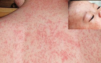 হামের প্রাদুর্ভাব:অভিভাবকরা কী করবেন,সরকার কী বলছে?