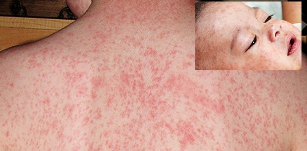 হামের প্রাদুর্ভাব:অভিভাবকরা কী করবেন,সরকার কী বলছে?