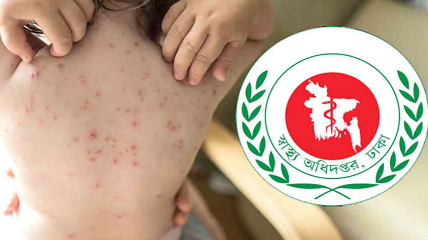 হাম ও হামের উপসর্গ নিয়ে আরও ৭ জনের মৃত্যু