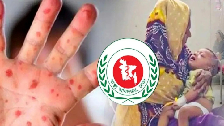 গত ২৪ ঘণ্টায় হাম উপসর্গে আরও তিনজনের মৃত্যু