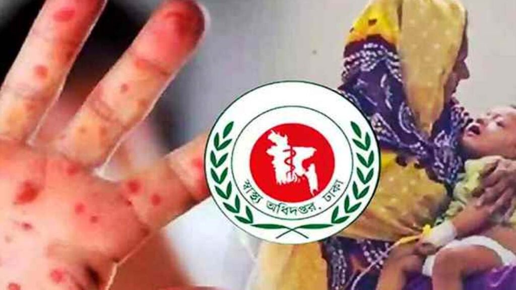 হামে আক্রান্ত শিশুদের ৬৫ শতাংশ পুষ্টিহীনতায় ছিলো: গবেষণা