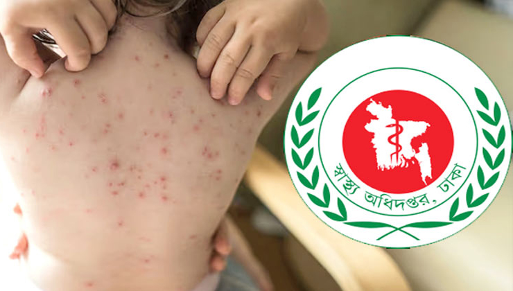 হামের উপসর্গ নিয়ে আরও ৭ জনের মৃত্যু