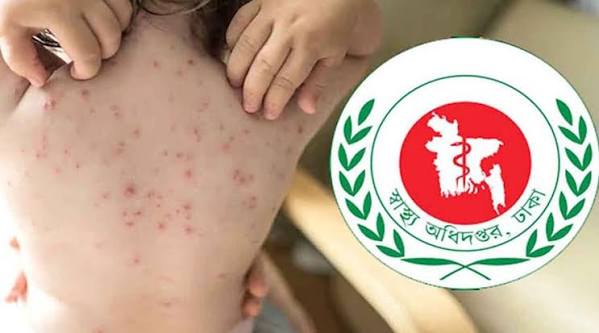 হাম ও হামের উপসর্গ নিয়ে গত ২৪ ঘণ্টায় দেশে আরও ৬ জনের মৃত্যু